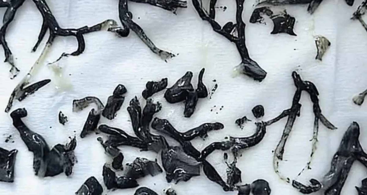 87 Yaşındaki Adamın Akciğerinde ‘Ağaç Dalları’nın Çıkarılması Şaşkınlık Yarattı